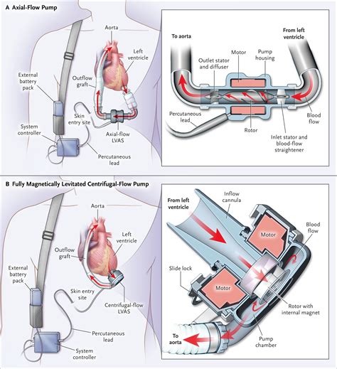 centrifugal heart pump|magnetic circulatory pump.